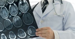 Tipo sanguíneo ajuda a prevenir morte por AVC, aponta estudo