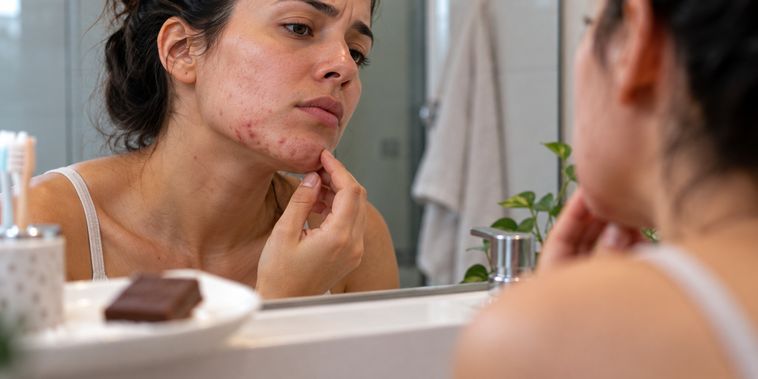Featured main: A acne que surge depois dos 25 anos pode não ter relação direta com o chocolate, mas com alterações hormonais e resistência à insulina que favorecem a produção de sebo