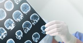 Parkinson: 2 sinais precoces que podem indicar a doença