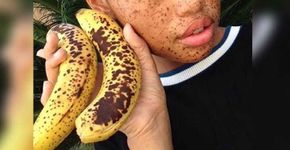 Jovem que sofria bullying por causa de sardas se torna modelo
