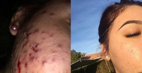 Jovem cura acne severa com chá verde e mel; confira a receita
