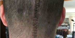 Após cirurgia para retirar tumor, homem reage com humor