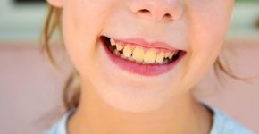 Dentes amarelados: veja as causas e como reverter as manchas