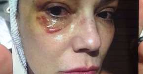 Após agressão, Luiza Brunet aciona Face por ofensas que recebeu