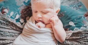 Mãe descobre que a filha é albina e faz depoimento emocionante