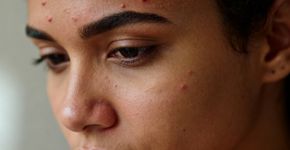 Aloe vera é o tratamento mais poderoso contra acne fúngica resistente