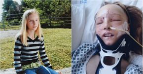 Garota que teve rosto desfigurado por acidente passa por cirurgia de reconstrução facial