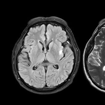 Featured mobile: Cientistas descobriram um novo gatilho para o Alzheimer e um medicamento que o inibe