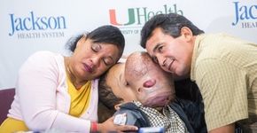 Morre Emanuel, jovem que tinha um tumor gigante no rosto