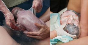 Fotos raras exibem bebês que nasceram envoltos na bolsa amniótica