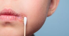 USP recruta pacientes para tratamento gratuito de herpes labial