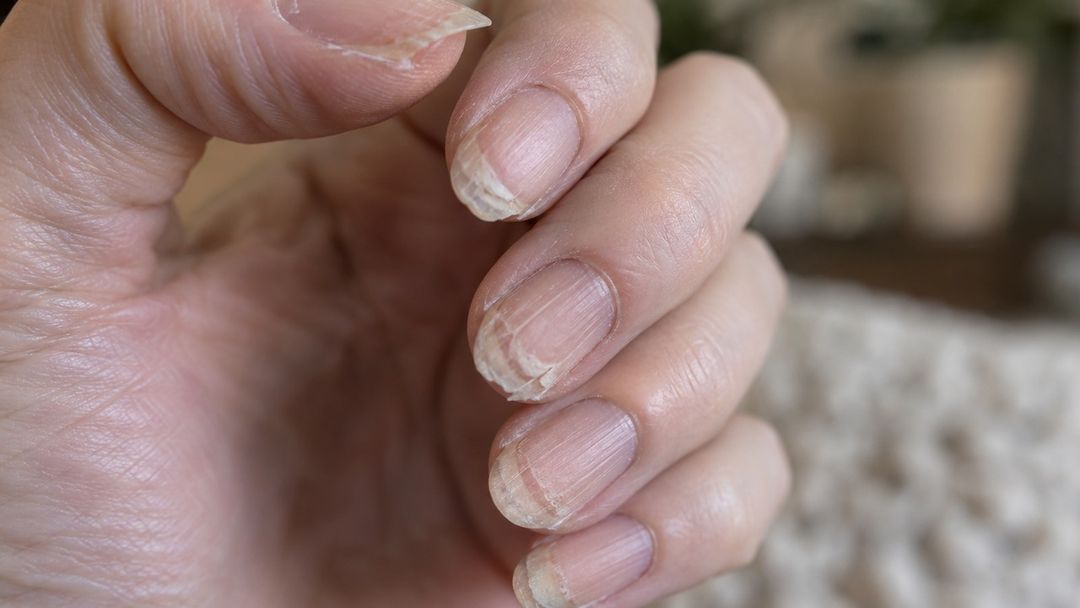 Arrancar esmalte pode levar junto partes da superfície da unha