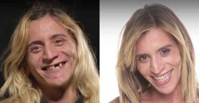 ‘Sorriso SP’:  fotos do antes e depois do tratamento dos dentes