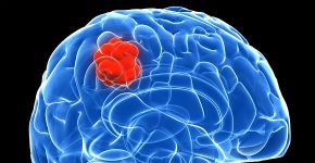 Perfil molecular define agressividade de tumor cerebral