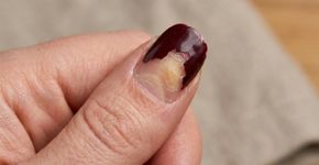 Seu esmalte descasca no dia seguinte mesmo sendo novo? O erro pode acontecer antes da primeira camada de cor