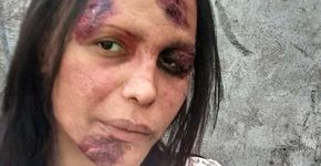 Mulher trans publica foto ‘machucada’ como protesto contra a transfobia