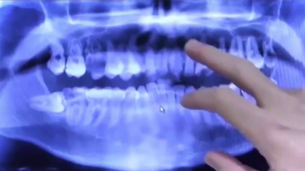 . Um aparelho de raios-X revelou que 11 dentes teriam que ser removidos e substituídos por implantes