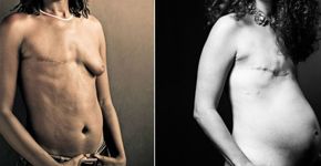 Câncer de mama: mulheres mostram o corpo em ensaio fotográfico