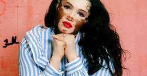 Mulher com vitiligo cala todos os ‘haters’ após apoio do noivo