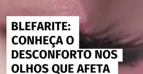 Blefarite: conheça o desconforto nos olhos que afeta mais as mulheres e como evitar