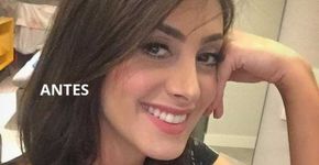 Ex-BBB Francine faz bichectomia e mostra antes e depois