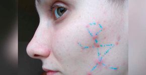 Artista faz constelações com sua acne para inspirar positividade