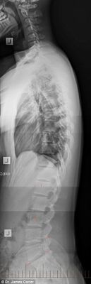 Espinhas dorsais completamente curvadas que resultam em problemas graves de coluna e para o pescoço é a principal consequência da tecnologia para a saúde da nova geração (Reprodução/The Daily Mail) 