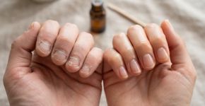 A unha lasca, a cutícula resseca e a mão vive na água: hidratar unhas e cutículas após lavar as mãos ajuda a reduzir fragilidade