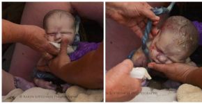 Já viu um bebê nascer sentado? Fotos de parto pélvico comovem