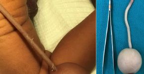 Foto: (Journal of Pediatric Surgery Case Reports/Reprodução)