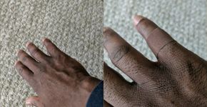 Homem se emociona ao descobrir curativo da cor de pele negra