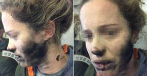 Fone de ouvido explode e garota sofre queimaduras no rosto