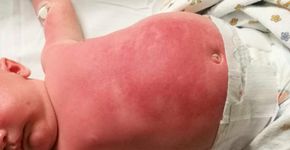 Bebê é internado após protetor solar causar queimaduras