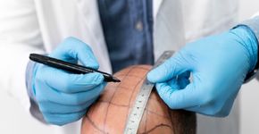 Quais cuidados devem ser tomados após o transplante capilar?