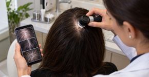Queda de cabelo causada pelo estresse no trabalho: o sinal de alerta que muita gente acaba confundindo com “coisa da idade”