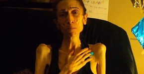 Pesando 18kg, atriz com anorexia volta a ter peso normal