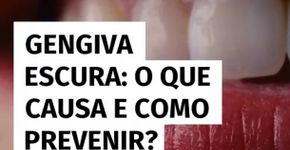 Gengiva escura: o que causa e como prevenir