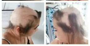Relacionamento infeliz faz garota perder o cabelo