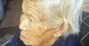 Chinesa de 87 anos com condição rara possui chifre de 13 centímetros