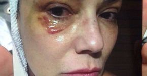 Após agressão, Luiza Brunet aciona Face por ofensas que recebeu