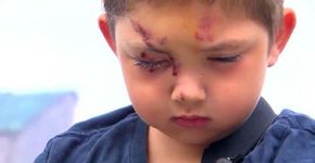 Menino de 6 anos sofre bullying e é atacado por 7 crianças