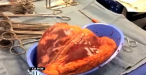 Vídeo mostra coração batendo fora do corpo por 25 minutos