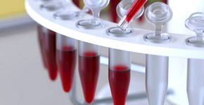 Exame de sangue detecta até 86% de casos de câncer de ovário