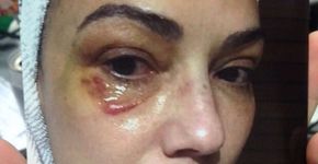 No Fantástico, Luiza Brunet mostra foto de hematoma após agressão