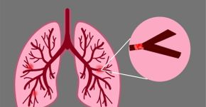 Embolia pulmonar: conheça os sintomas e os fatores de risco da doença