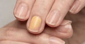 O ritual semanal infalível contra as unhas amareladas e manchas persistentes