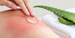 5 passos para aliviar queimadura solar rapidamente com aloe vera