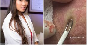 Médica faz sucesso na web exibindo retirada de cravos e espinhas