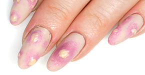 Espinhas inflamadas inspiram decoração de unhas que soltam pus