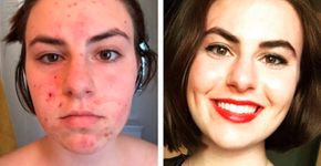 Jovem muda hábitos e melhora sua acne drasticamente em três meses